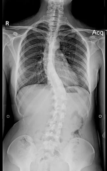 Illustrative X-ray showing a sideways spinal curve