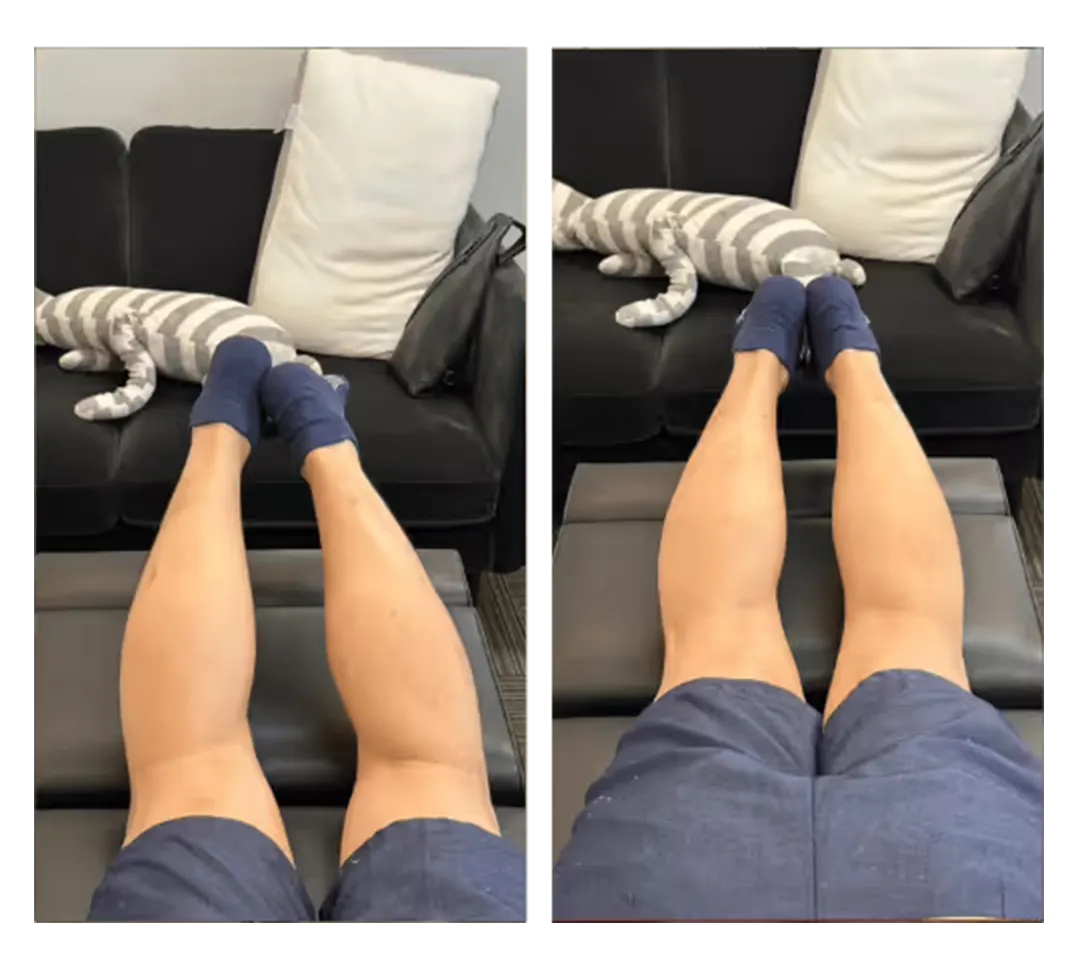 Posture before and after treatment — 