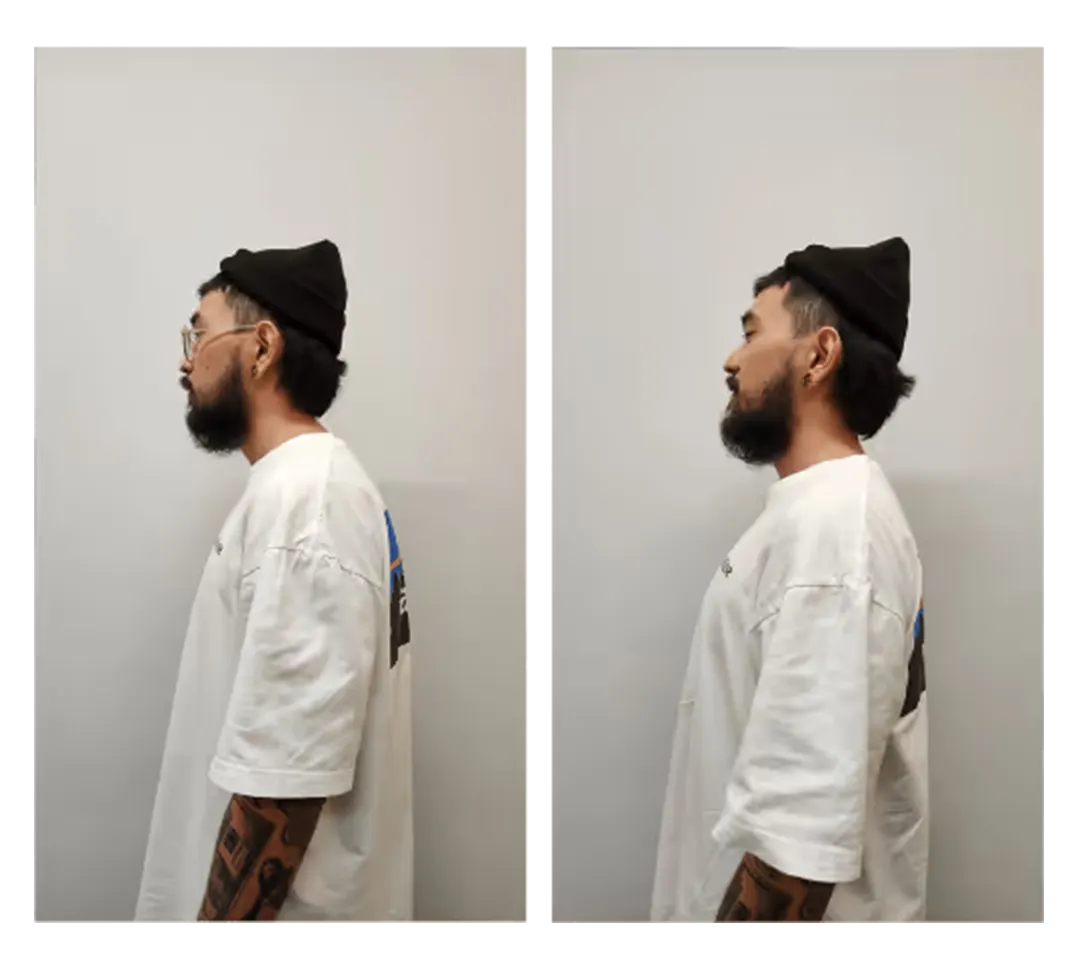 Posture before and after treatment — 