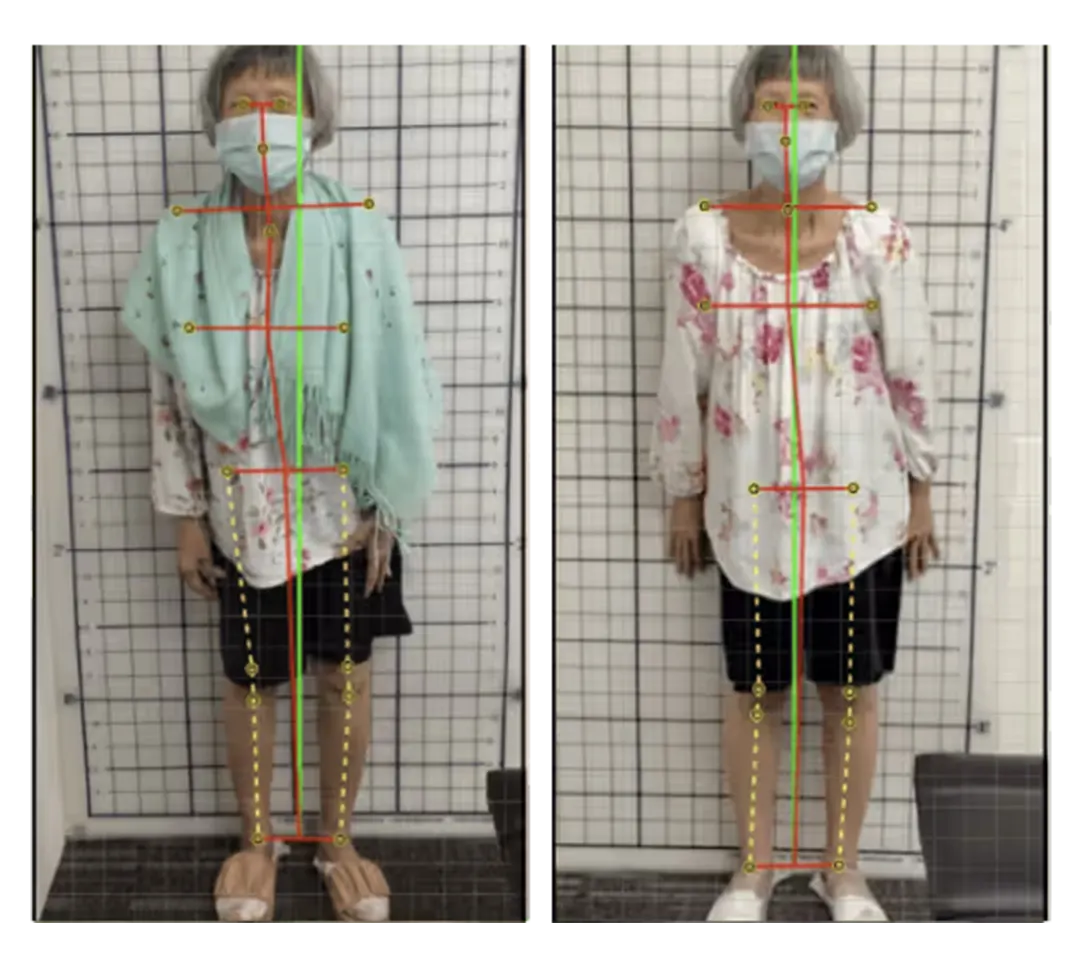 Posture before and after treatment — 