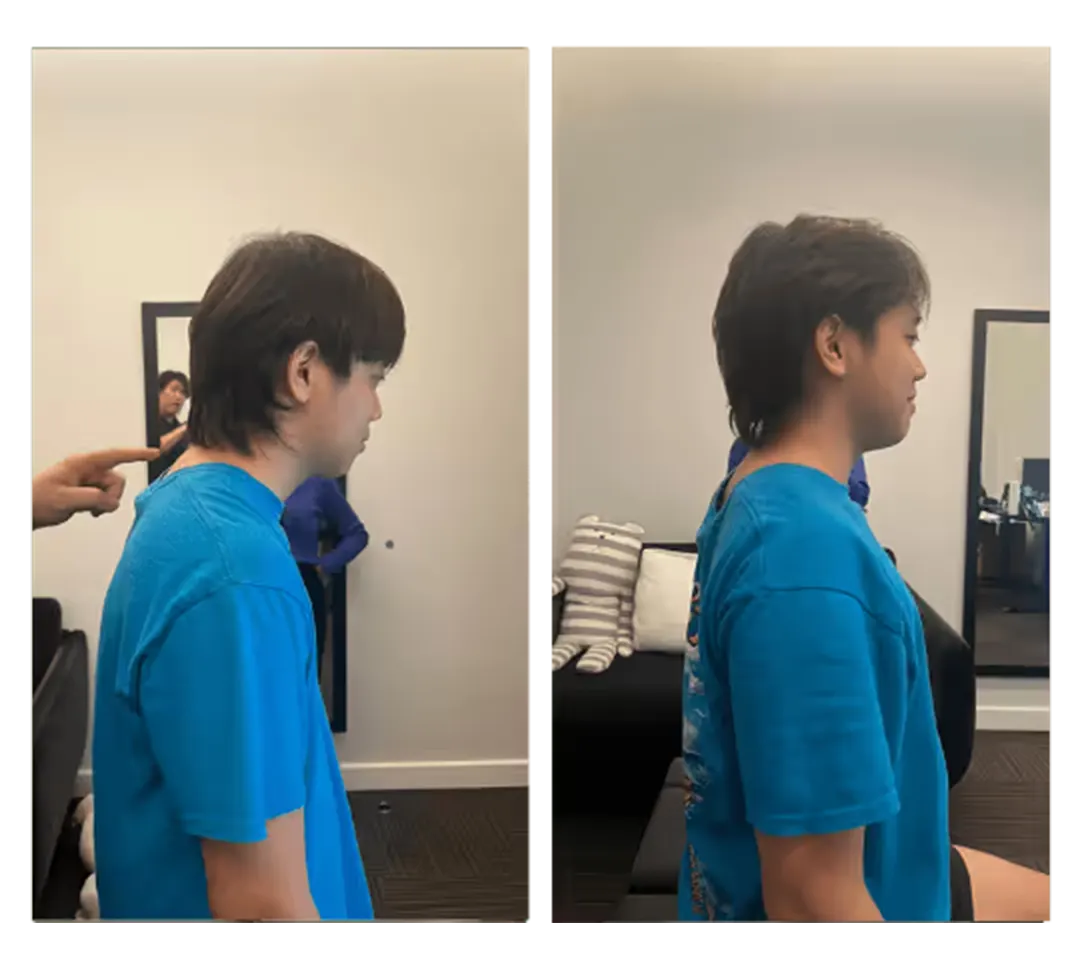 Posture before and after treatment — 